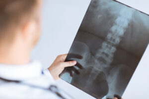 Personal Injury Lawyer Dublin OH - close up of male doctor holding x-ray or roentgen image